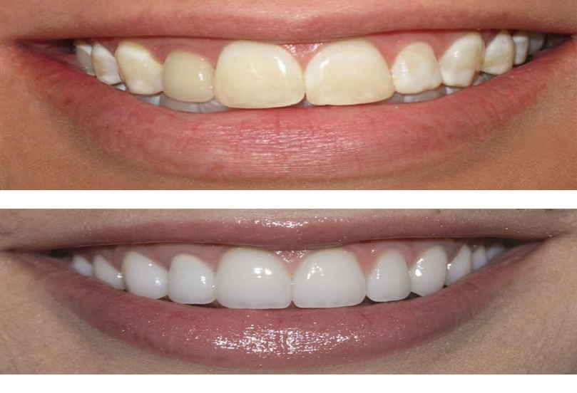 Teeth Whitening